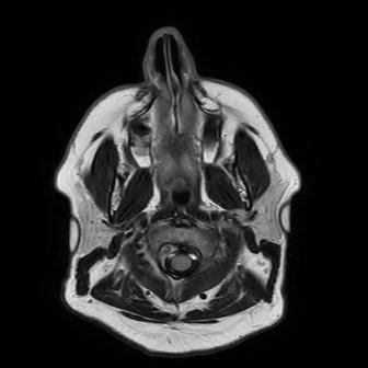 2022 Full Body MRI.ax_flair_head.0002.dcm.jpg